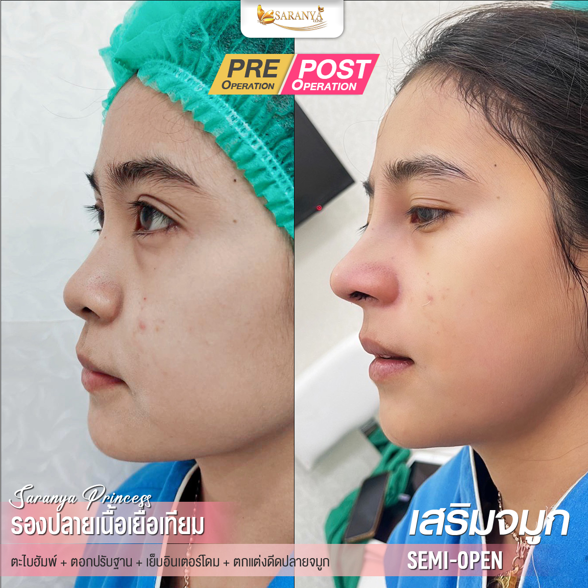 รวม 10 คลินิกเสริมจมูก ราคาไม่แพง ฝีมือดี จ่ายแค่หลักพัน - ออนฟอน | Onfond